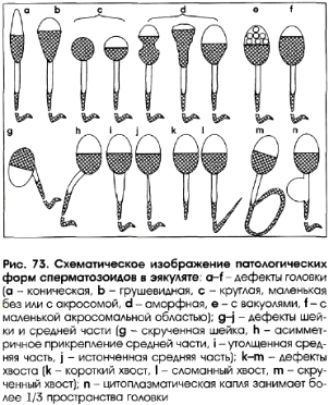 Как лечить патологическую форму сперматозоидов Как лечить патологическую форму сперматозоидов