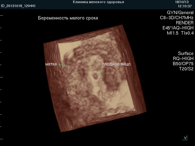 3d узи при беременности екатеринбург