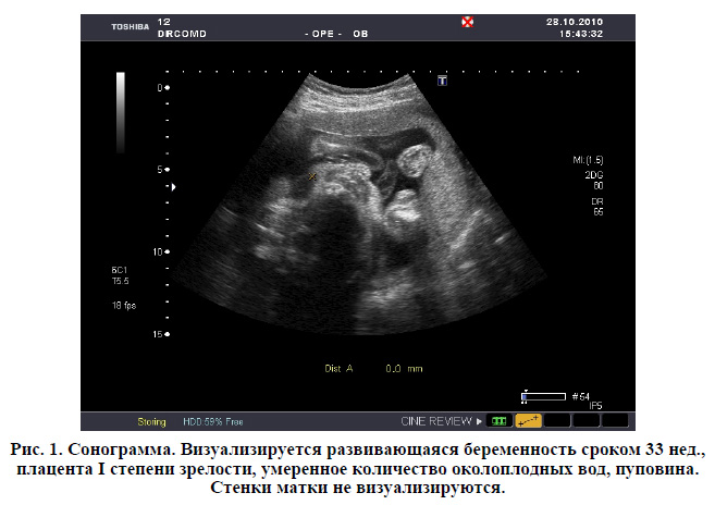 При беременности эко может тянуть яичник