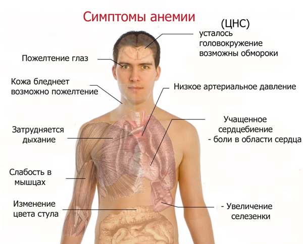 Может ли при анемии болеть суставы Может ли при анемии болеть суставы
