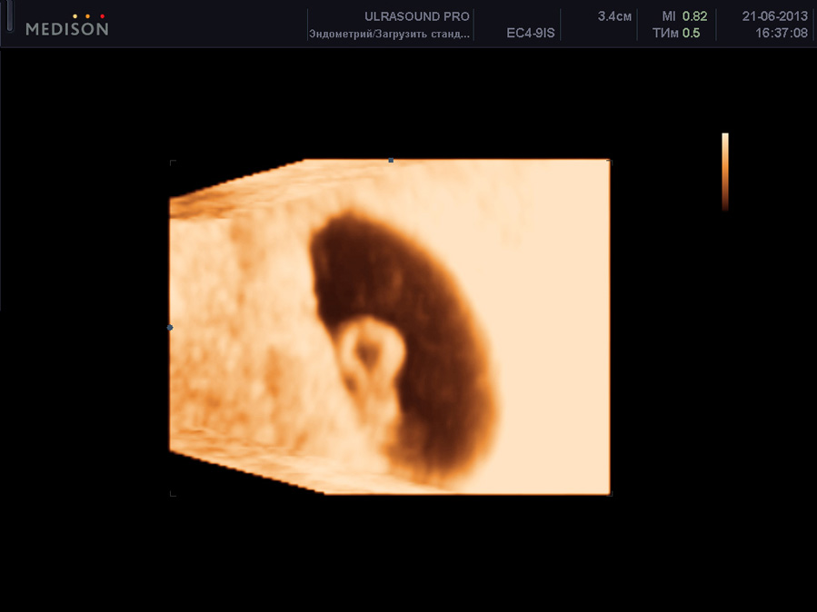 Эмбрион фото узи. Эмбрион на 6 неделе беременности УЗИ. 6 Недель беременности фото плода на УЗИ. Эмбрион 5 6 недель беременности УЗИ. 3д УЗИ на 6 неделе беременности.