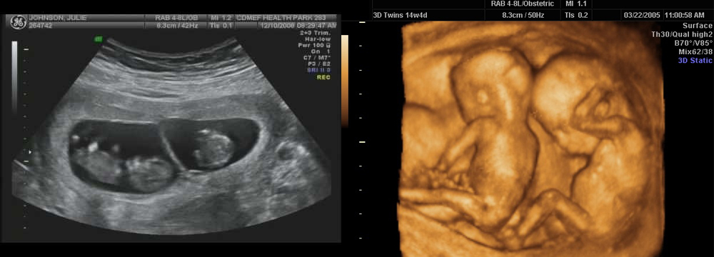 Узи 40 недель. УЗИ 8 недель беременности двойня. УЗИ 12 недель беременности двойня. УЗИ двойняшек на 8 неделе беременности. Двойняшки на УЗИ 12 недель беременности.