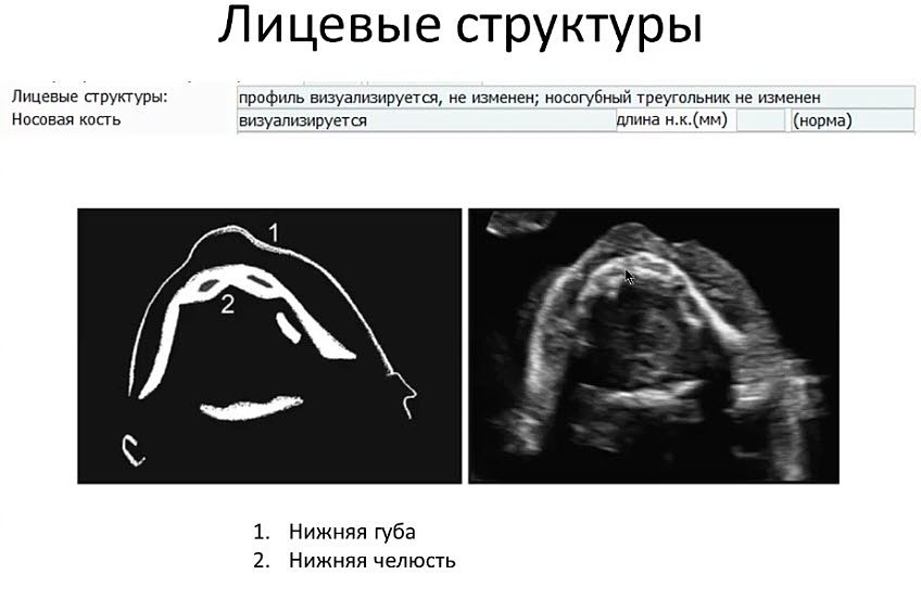 Видеолекции узи изранов. Ультразвуковая анатомия плода. Подбородок плода на УЗИ. Изранова лекции по УЗИ.