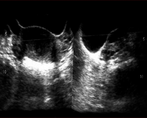 Жидкость в дугласовом пространстве. Гидатиды маточной трубы на УЗИ. Гидатиды маточных труб.