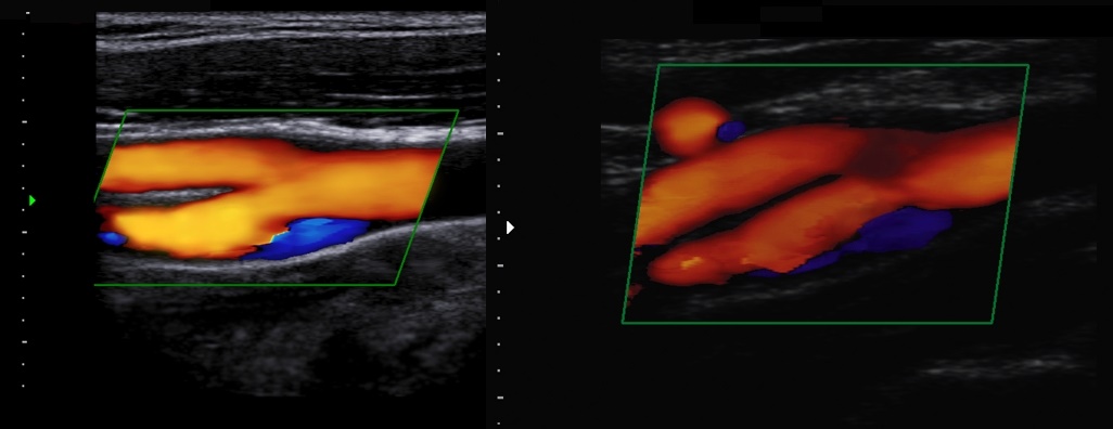 Бляшки в шейной артерии что делать. Стеноз сонных артерий на УЗИ. Стеноз сонной артерии УЗДГ. Атеросклероз сонных артерий УЗИ. Атеросклероз допплерография сосудов шеи.