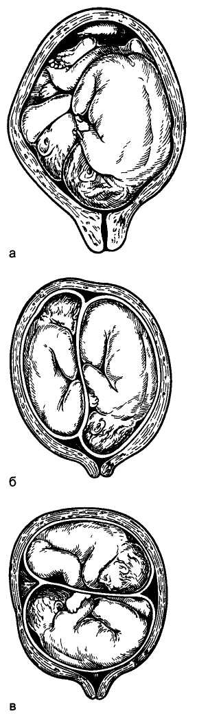 Плод расположен. Поперечная предлежание плода двойня. Предлежание плодов при многоплодной беременности. Многоплодная беременность расположение плодов. Поперечное предлежание плода при двойне.