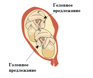 Головное продольное предлежание плода