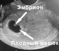 Плодный мешок. Желточный мешок и эмбрион на УЗИ. Плодное яйцо и желточный мешочек. Плодное яйцо и желточный мешок.