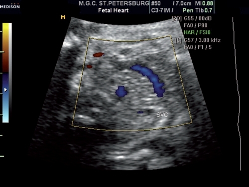 Персистирующая вена у плода. Венозный проток на узи. Венозный проток у плода на узи. Персистирующая левая верхняя полая вена. Венозный проток пупочная вена.