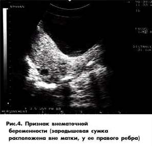 Внематочная Беременность Фото Узи