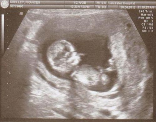 Конец 18 недели. 18 Недель беременности фото плода на УЗИ. Эмбрион на 18 неделе беременности фото УЗИ. Малыш на 18 неделе беременности УЗИ. УЗИ 18 недель беременности.