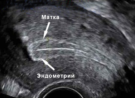 Эндометрий 4 1. Оплодотворенная яйцеклетка на УЗИ. Трехслойный эндометрий. Трехслойный эндометрий на УЗИ.