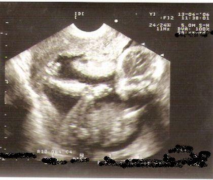 17 недель беременности фото узи