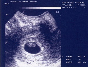 Криоперенос узи. УЗИ 5-6 недель беременности после эко. Первое УЗИ при беременности после эко. 6 Недель беременности после эко.