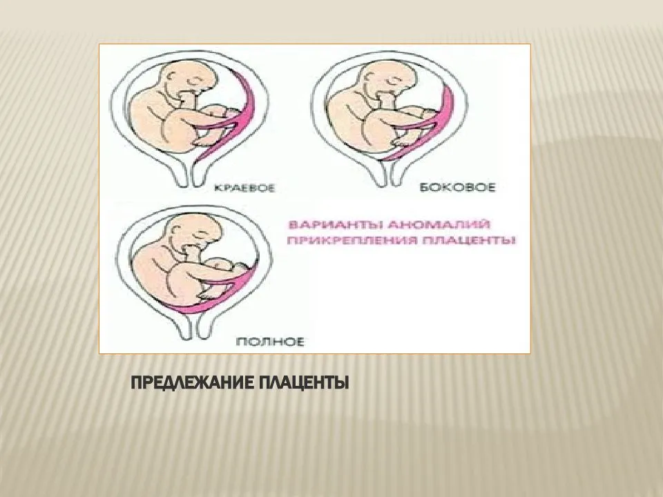 Плацента на какой неделе. Предлежание плаценты. Низкая плацентация краевое предлежание. Низкая плацента при беременности. Расположение плаценты при беременности.