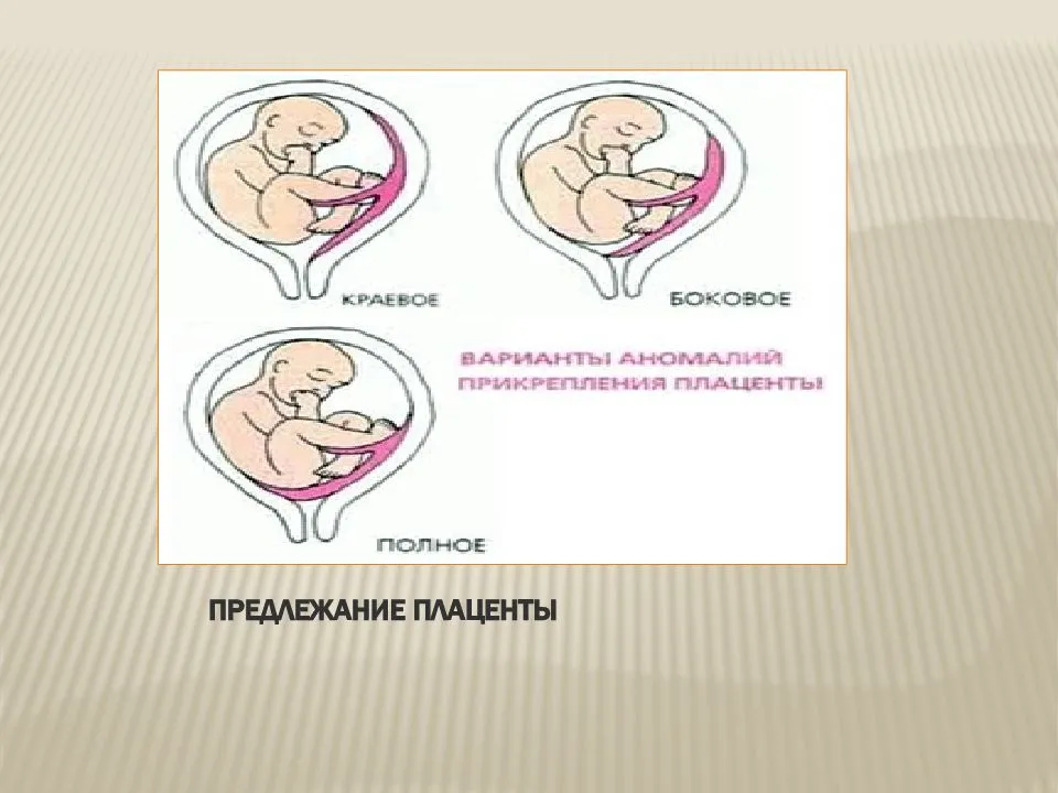 Низкая беременность. Низкая плацента при беременности. Расположение плаценты при беременности. Переднее прикрепление плода. Низкая краевая плацентация при беременности.