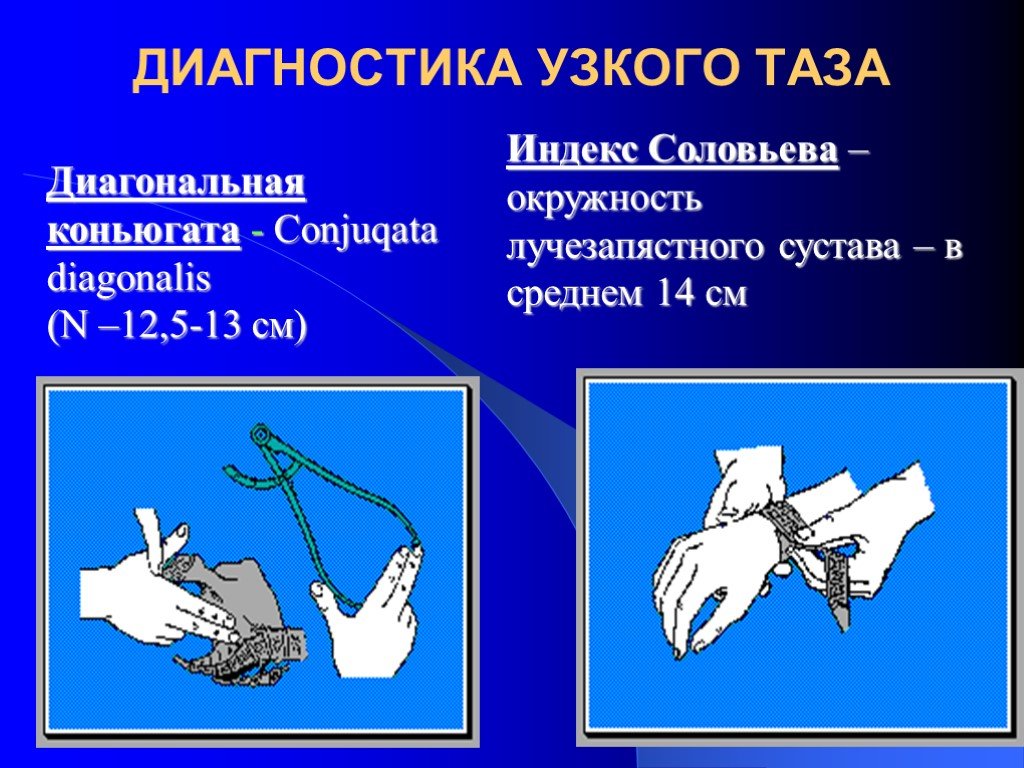 Узко понимаемый. Методы диагностики узкого таза. Диагностика узкого таза Акушерство. Индекс Соловьева.